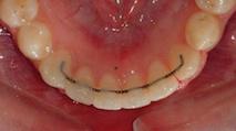 Bonded retainer stuck behind lower front teeth 1 (Original size)